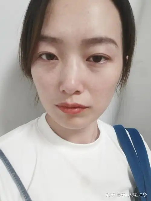 鼻骨骨折医生不建议手术,但是鼻子有凸起怎么办?手术花费多少?