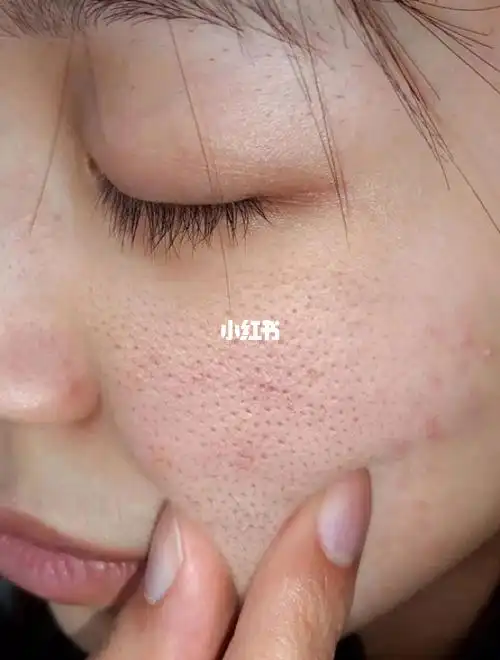 脸上的黑头闭口痘痘都没了_闭合性粉刺_黑头_痘痘_闭口痘痘_祛痘_清洁