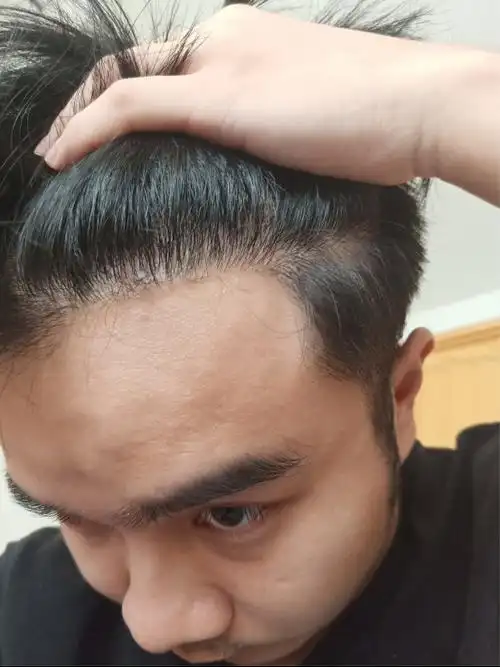 疤痕种植 发际线调整我这个并不是发际线后移,而是从,发际线正常吗