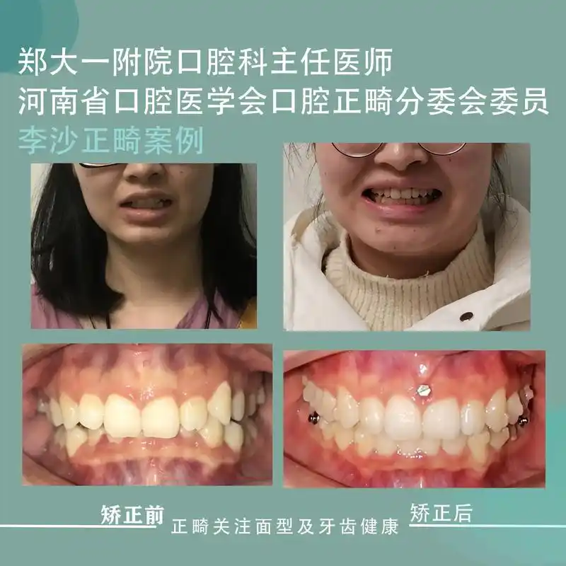 上颌采取磨牙后推及前牙 - 抖音