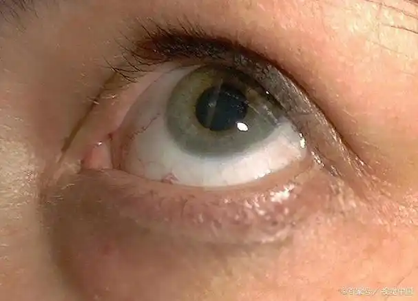 水肿从眼睛到四肢,才发现是肾炎,医生:别急,先从水肿"下手"