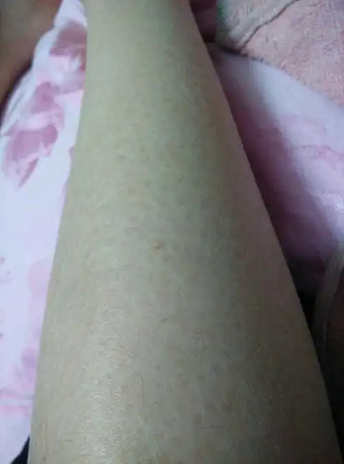 小腿上干燥出现一些像斑一样的 是不是鱼鳞斑 怎么去除?有效点的方法