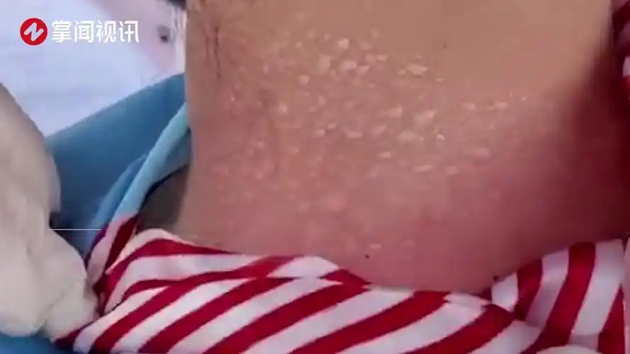 高温天里护士被晒伤脖子起密密麻麻的水泡