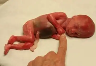 内裤兜胎儿实在太惊悚了,没有能力抚养就要洁身自爱啊,而且私自吃