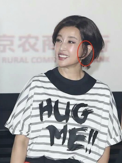刘晓庆的耳朵怎么了