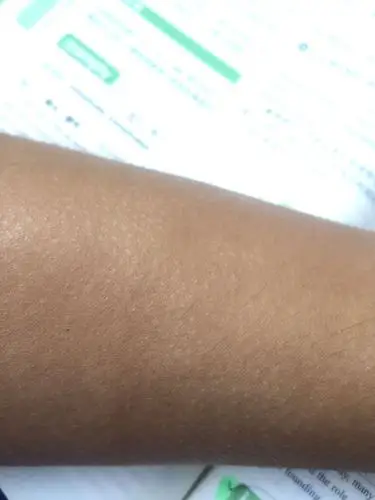 手臂毛孔周围发白,毛孔上有很小很小排泄物,一晒太阳或者热水洗澡稍微