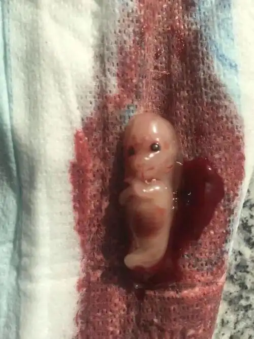 你知道堕胎对一个女人的伤害有多重吗知道被流掉的孩子有多痛吗