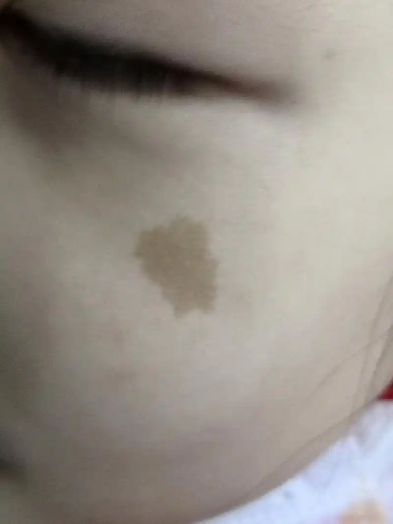 面部咖啡斑症状.可以手术切除治疗.美容效果不错的#美容##皮肤外科