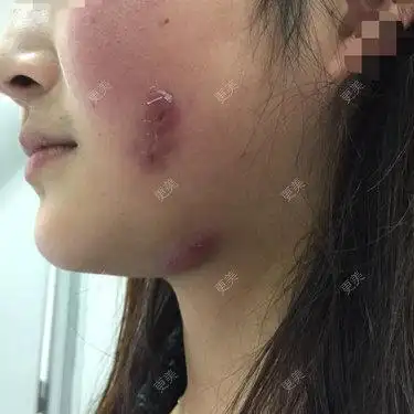 溶脂针注射后局部感染破溃后期会有疤痕凹陷溶脂针目前国家药监局没