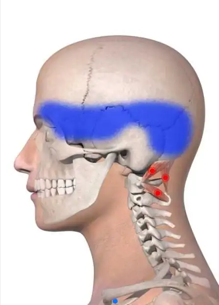 头昏昏沉沉的元凶——枕下肌群 - 简书