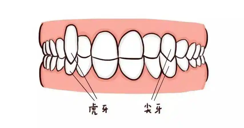 西安圣贝口腔科普丨虎牙该不该被拔掉?_牙齿_的作用_位置