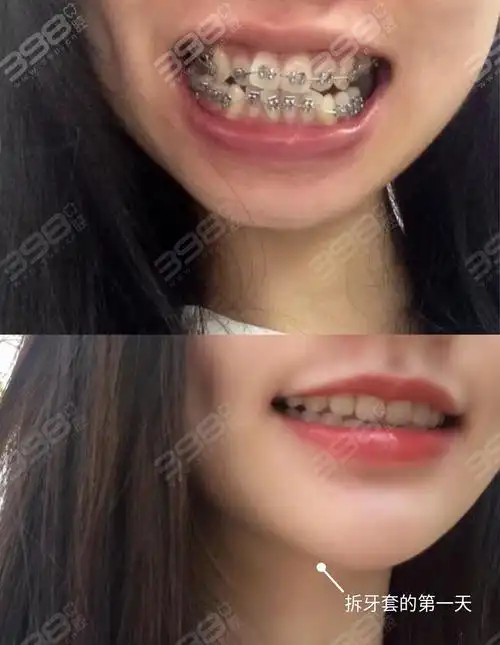 矫正案例前后对比