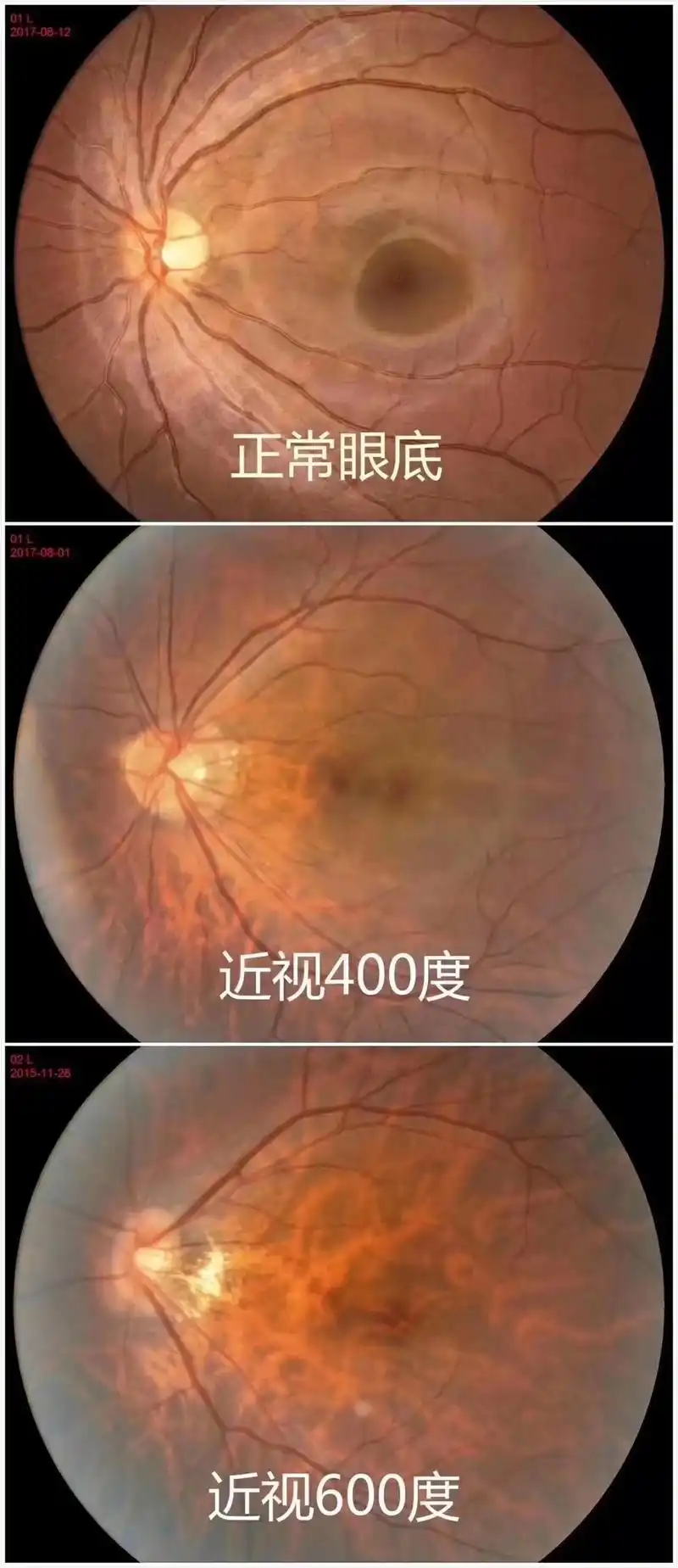 高度近视为什么会这么可怕易视界