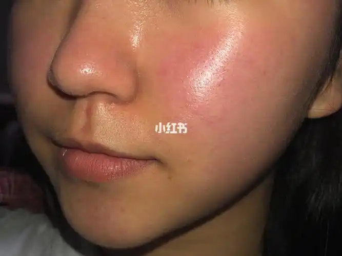 油皮敏感肌 角质层薄 皮肤泛红发烫 求各位大神帮忙推荐一下有没有亲