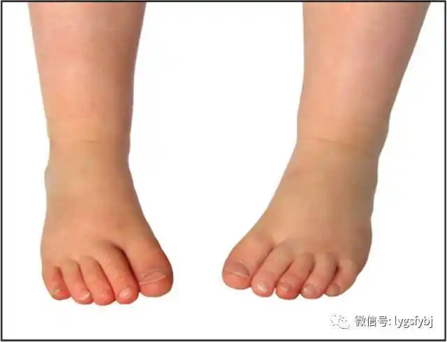 小孩走路外八字内八字应该怎么办