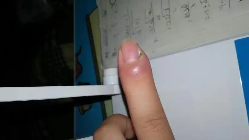 左手食指尖肿 指尖硬 轻轻捏上去都痛 一个周左右