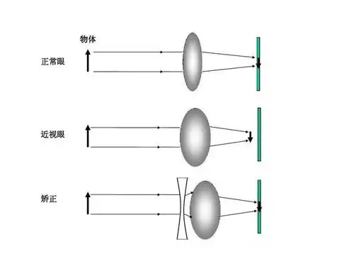 眼轴变长近视眼成像在视网膜前是模糊的