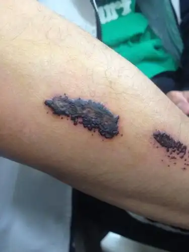 骑车摔伤,伤口结痂了,为什么是这种颜色?严重吗?