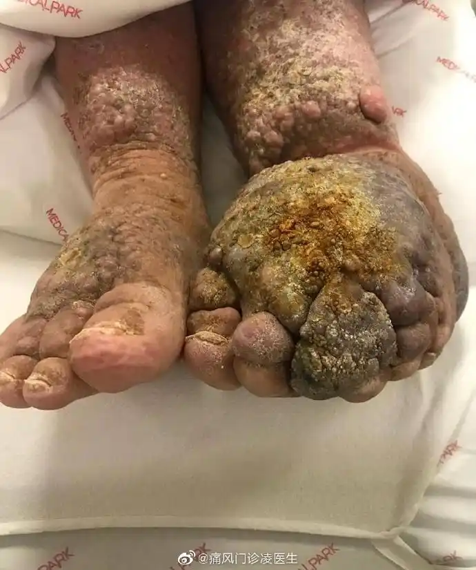 可能引起不适的图片:慢性下肢淋巴管堵塞(象皮腿)#随手医学科普