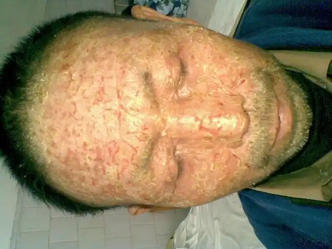 今天遇到一个皮肤病患者,很严重