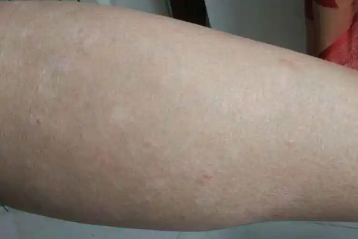 汗斑小腿皮肤有白色斑片图