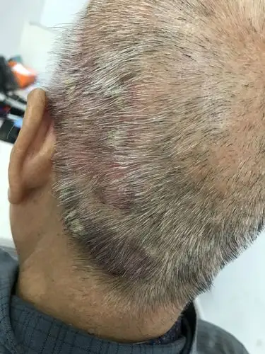 头皮真菌病一例治疗前后对比 - 好大夫在线