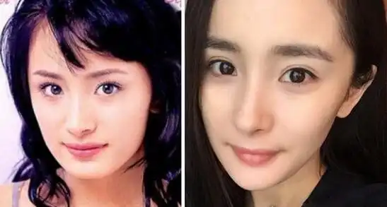 杨幂整容前后照片对比整容失败留下后遗症曝光