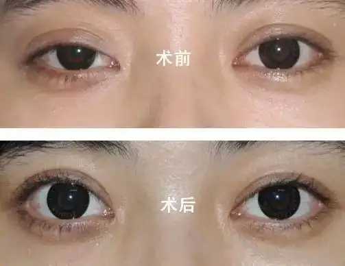 眼睛上睑下垂很严重,怎么办?