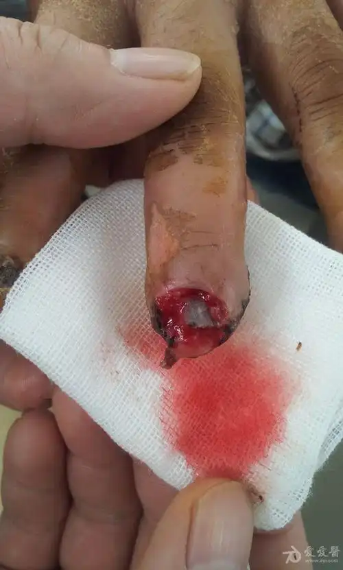 左手中指甲床坏死,指骨外露坏死,请问有什么好的治疗方案
