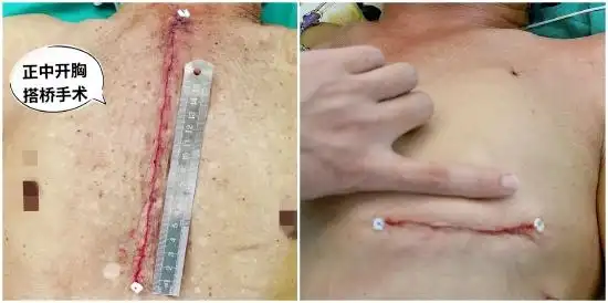 厦大附属心血管病医院在福建独家开展微创多支搭桥手术及一站式杂交