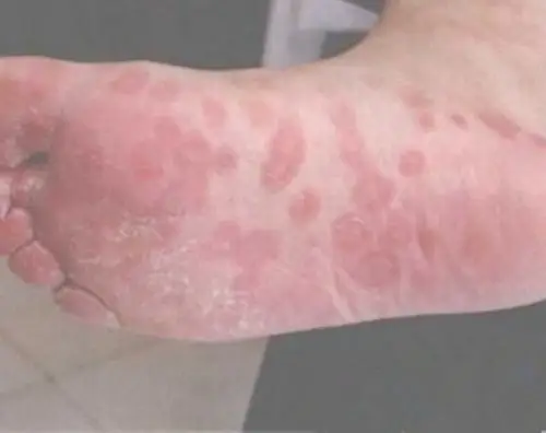 人得了一期梅毒怎么办图片