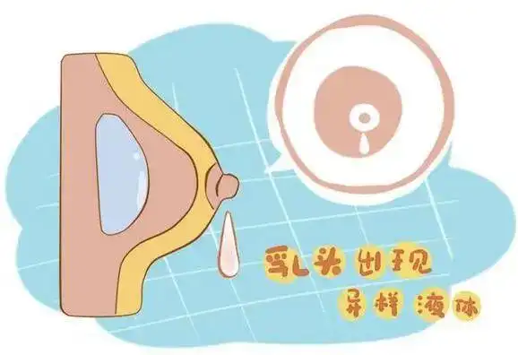 非妊娠期从乳头流出血液,浆液,乳汁,脓液,或停止哺乳半年以上仍有乳汁