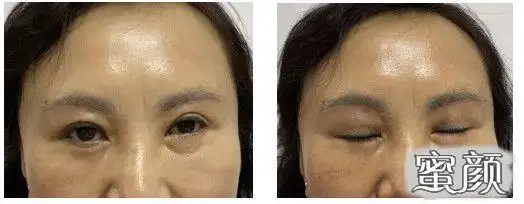 美然眼睑下垂矫正术还您明亮双眸复您靓丽容颜