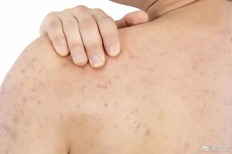 第三类:毛周角化(鸡皮肤)且皮肤的表皮基底层不断制造细胞,并输送到