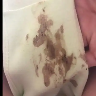 怀孕一个月天天有这个褐色分泌物怎麼办啊 可以吃点抗生素吗