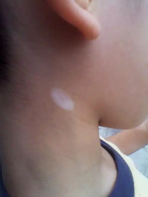 小儿白癜风一例