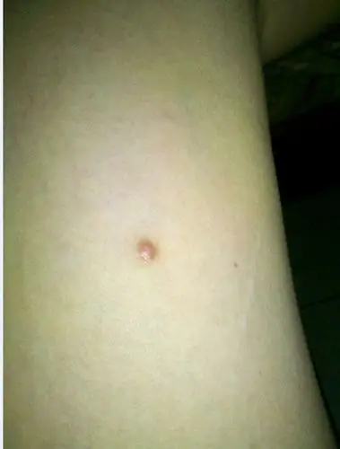 大腿皮肤有个小突起