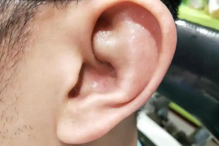 耳廓假性囊肿图