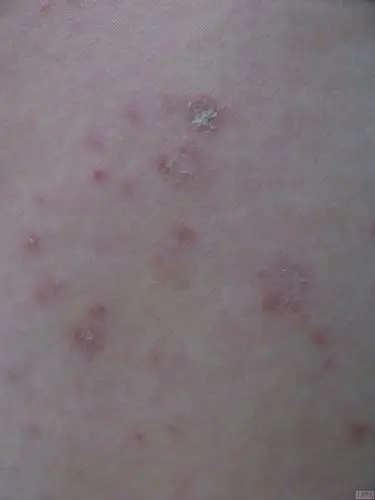 求助我得的是哪种皮肤病新上传图片及病理图片