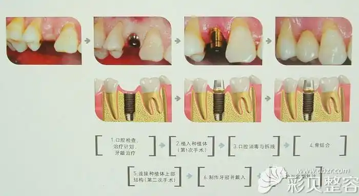 种植牙过程示意图