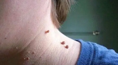 青海疣医院_青海治疗疣哪家医院好_青海治疗疣最好的医院/排行_有来