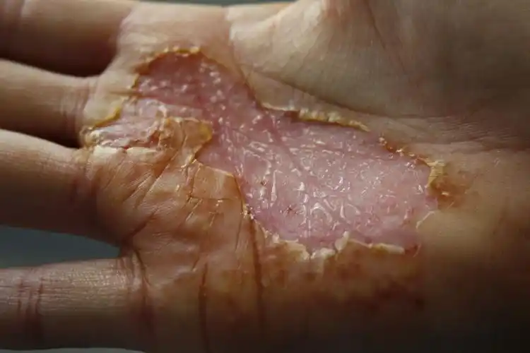 我想确定一下我这是什么病,究竟是掌跖脓包病还是鹅掌风