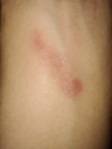 就是手腕处烫伤了表皮愈合以后皮肤下面看着红红的好像只是表皮