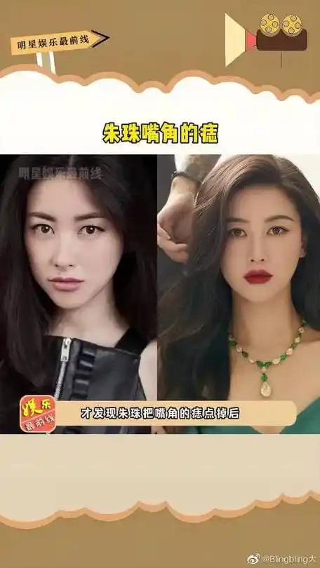 朱珠?嘴角的痣,去掉后