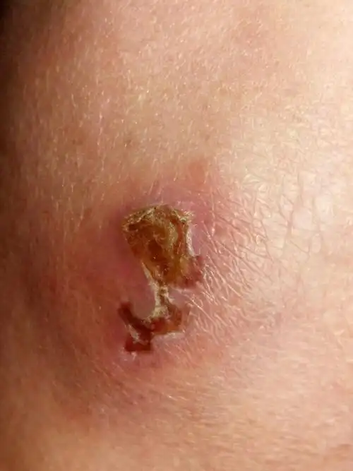 之前烫了一个泡挑破了慢慢的结痂了就成这样了有没有事