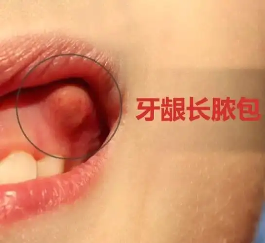 939393牙龈出现脓包,多数要归因于牙齿健康问题,当出现牙周相关