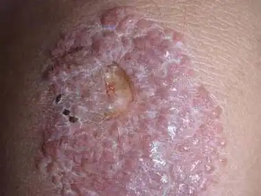 接触性皮炎症状及图片长什么样