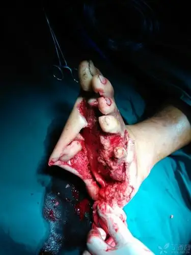 足部碾压伤,紧急求助! - 骨科专业讨论版 -丁香园论坛