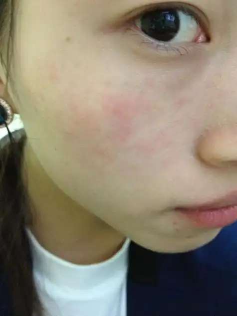 脸部皮肤过敏红肿怎么办(脸部皮肤过敏红肿痒怎么办)-大恒文化