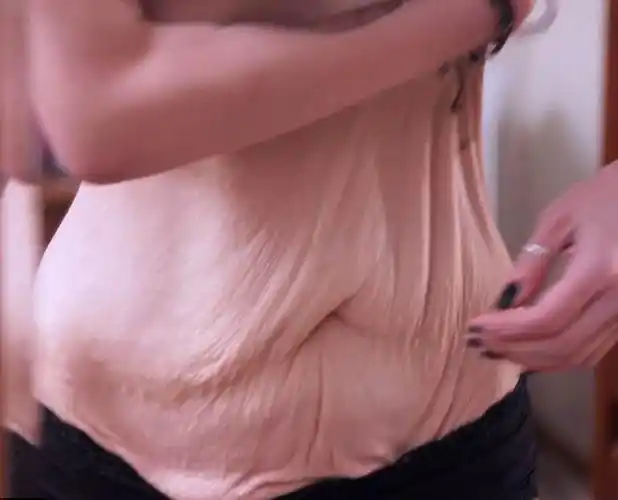 惊人外国一女子狂减91公斤皮肤严重松弛